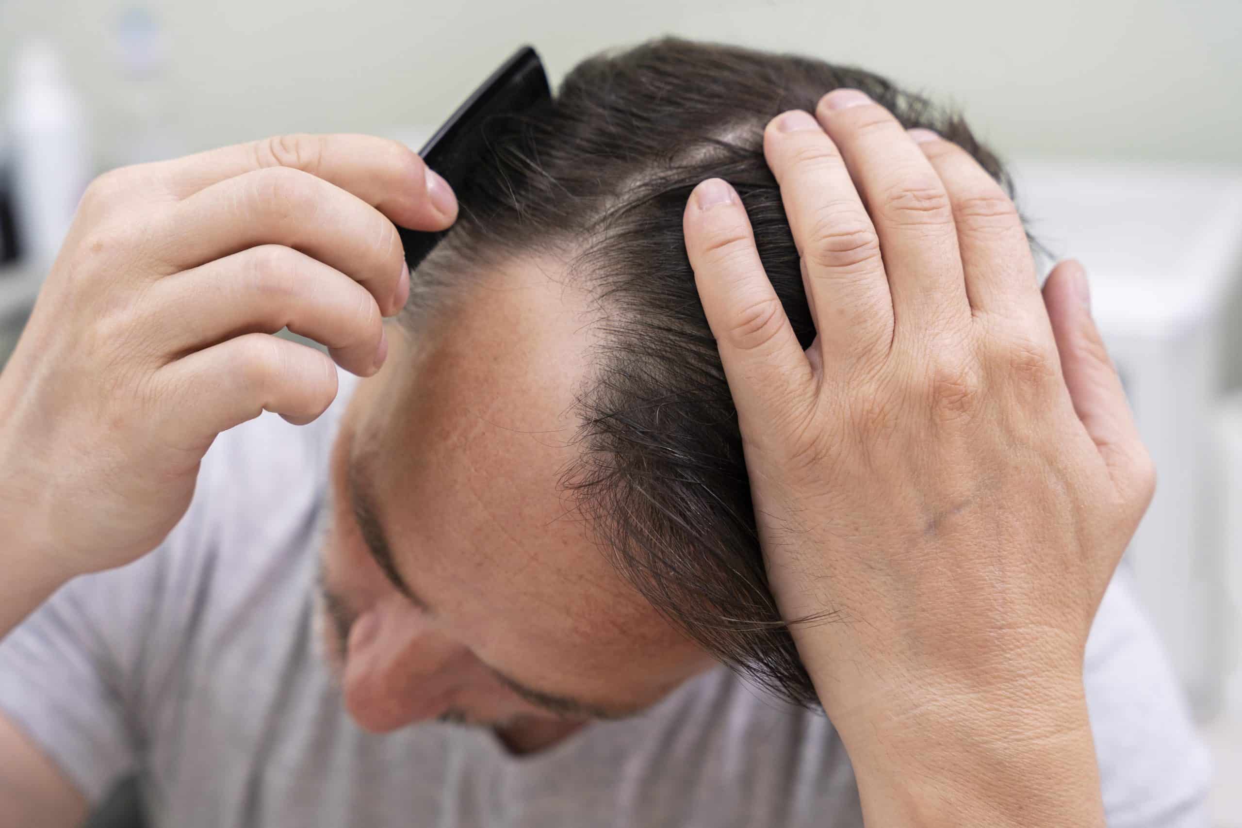 Nova fórmula revolucionária promete resultados superiores ao minoxidil e finasterida no tratamento da calvície
